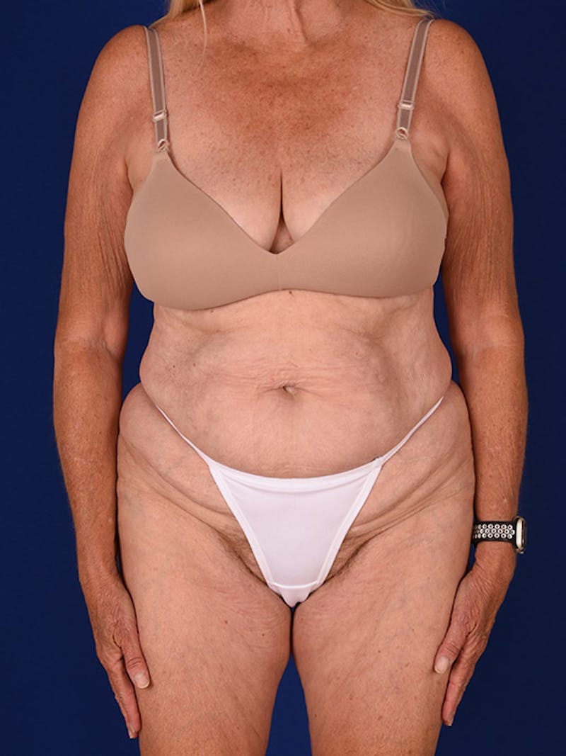 Mommy Makeover Before & After Gallery - Patient 18242610 - Image 1