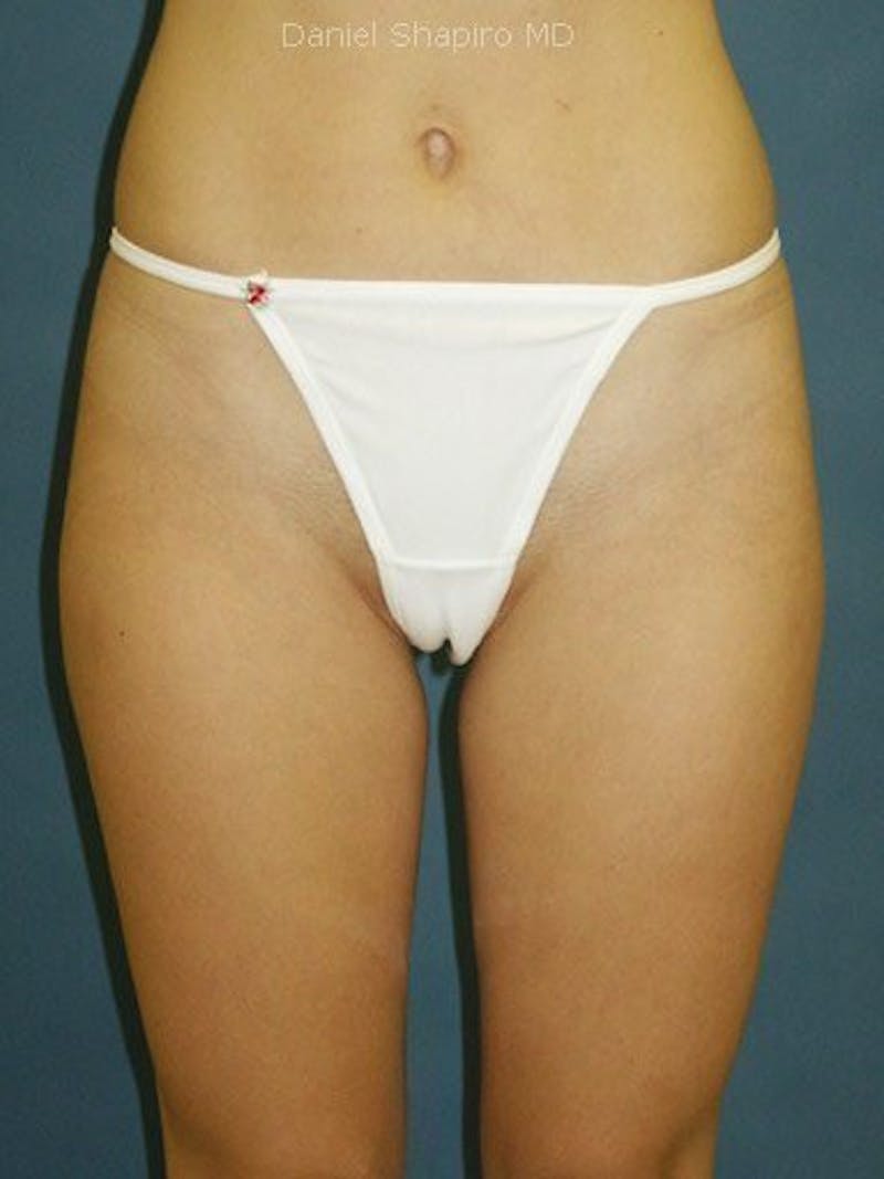 Liposuction Before & After Gallery - Patient 18242447 - Image 2