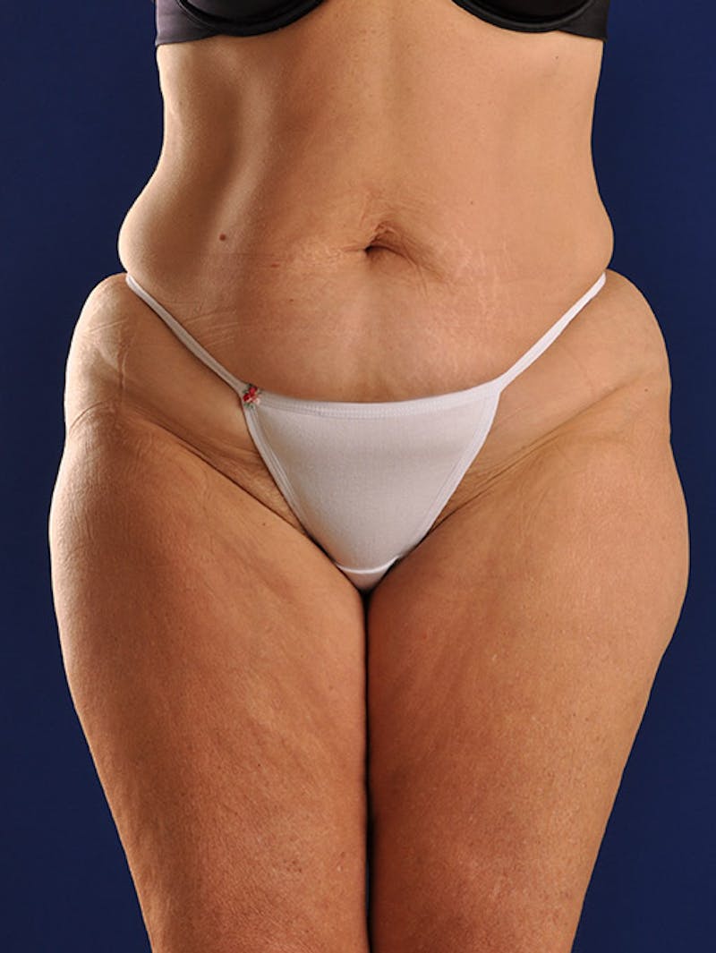 Abdominoplasty / Tummy Tuck Before & After Gallery - Patient 18242611 - Image 1
