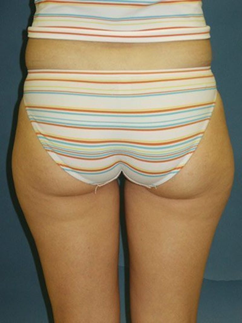 Liposuction Before & After Gallery - Patient 18242447 - Image 3
