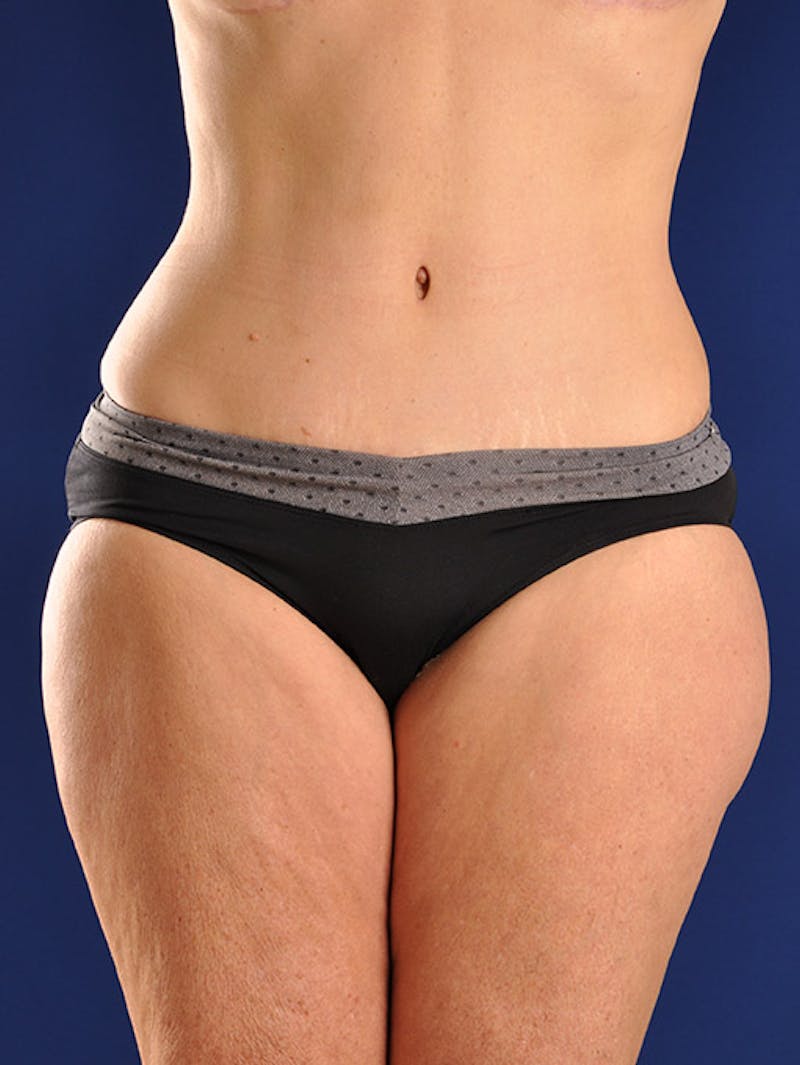 Abdominoplasty / Tummy Tuck Before & After Gallery - Patient 18242611 - Image 2