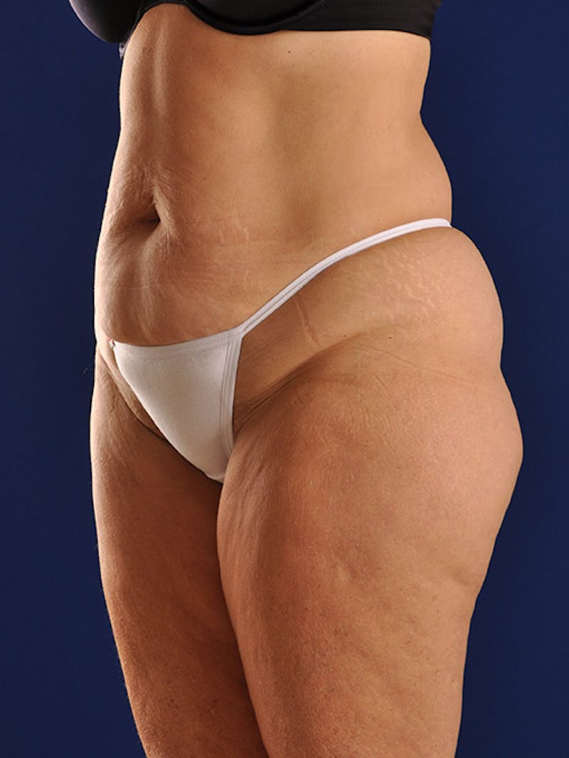 Abdominoplasty / Tummy Tuck Before & After Gallery - Patient 18242611 - Image 3