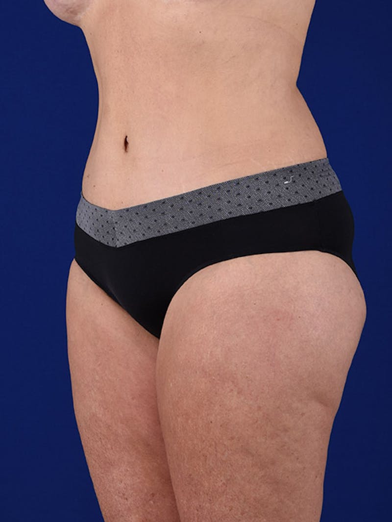 Abdominoplasty / Tummy Tuck Before & After Gallery - Patient 18242611 - Image 4