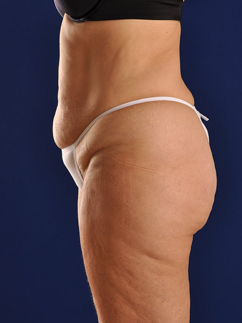 Abdominoplasty / Tummy Tuck Before & After Gallery - Patient 18242611 - Image 5