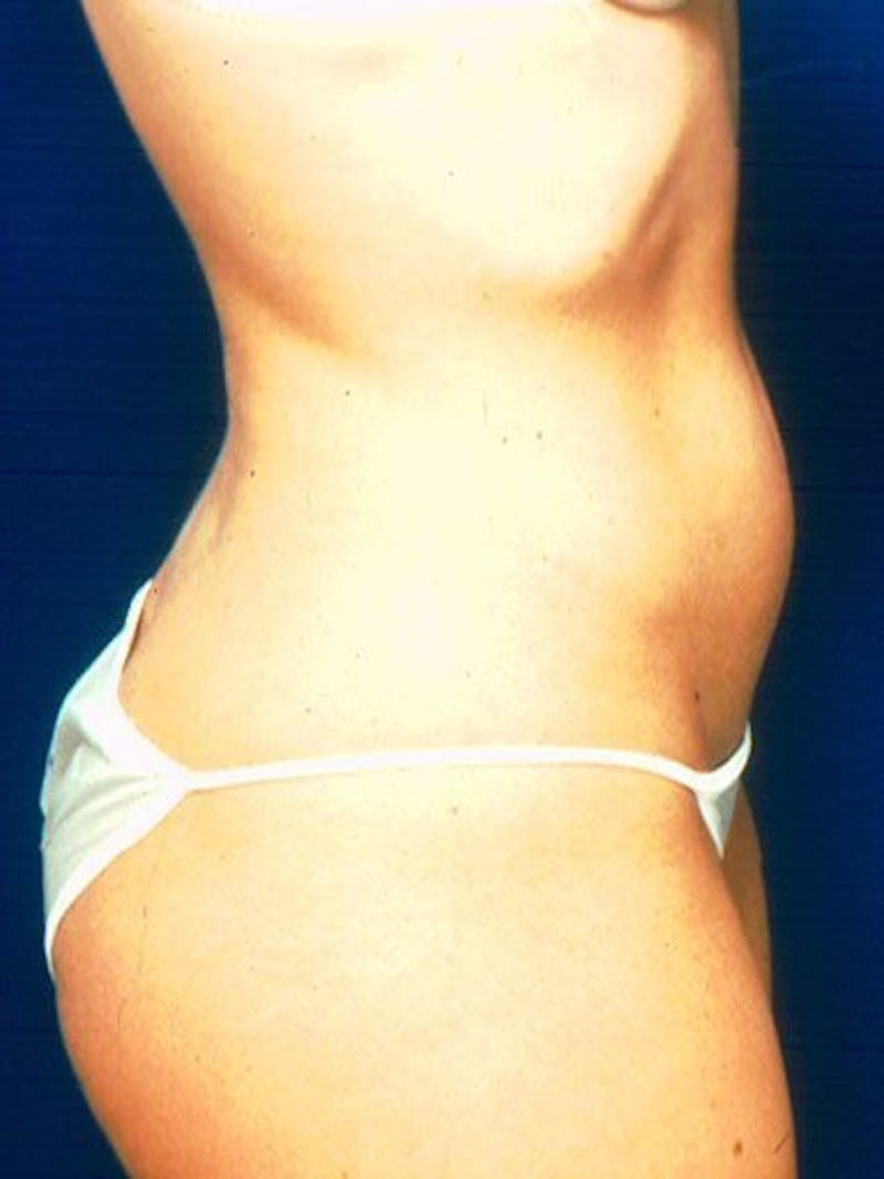 Liposuction Before & After Gallery - Patient 18242612 - Image 3