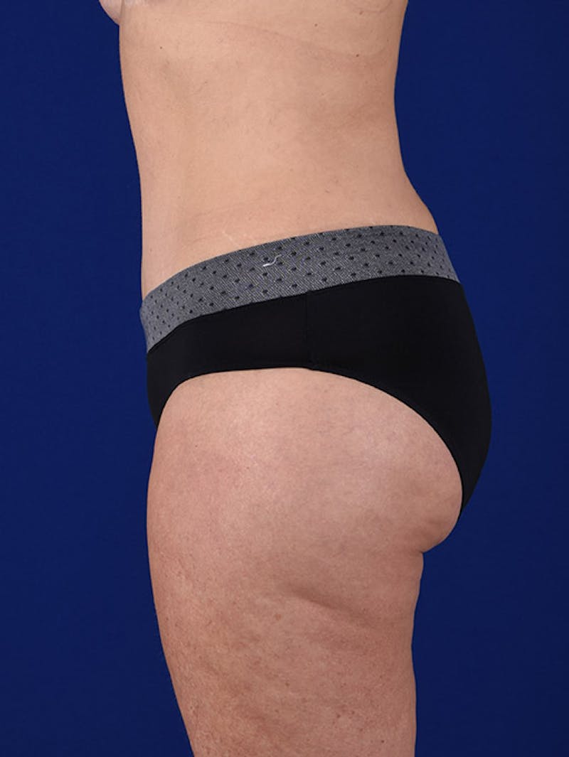 Abdominoplasty / Tummy Tuck Before & After Gallery - Patient 18242611 - Image 6