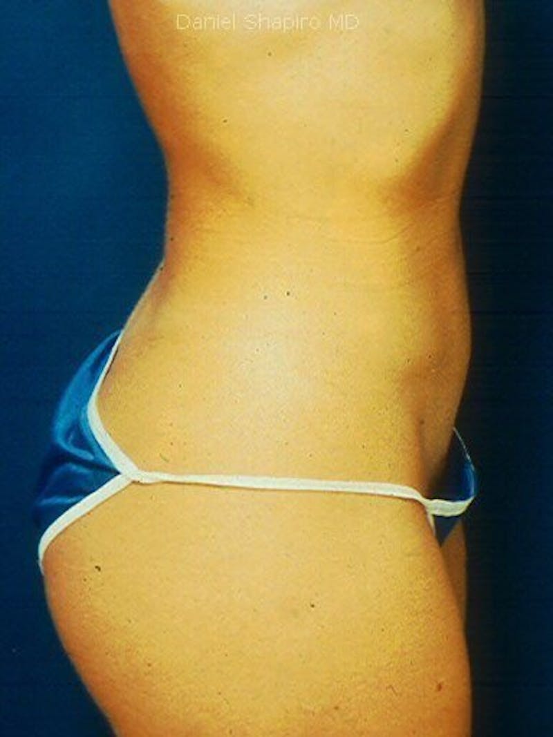 Liposuction Before & After Gallery - Patient 18242612 - Image 4