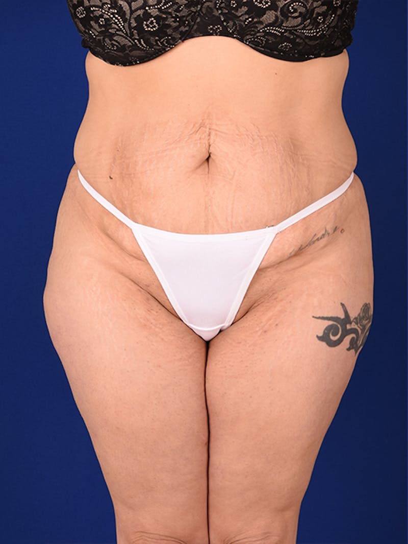 Abdominoplasty / Tummy Tuck Before & After Gallery - Patient 18242776 - Image 1