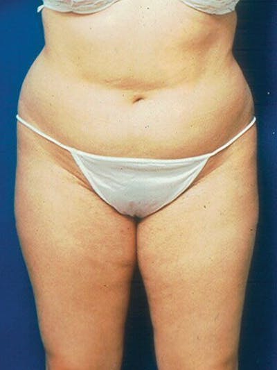 Liposuction Before & After Gallery - Patient 18242613 - Image 1