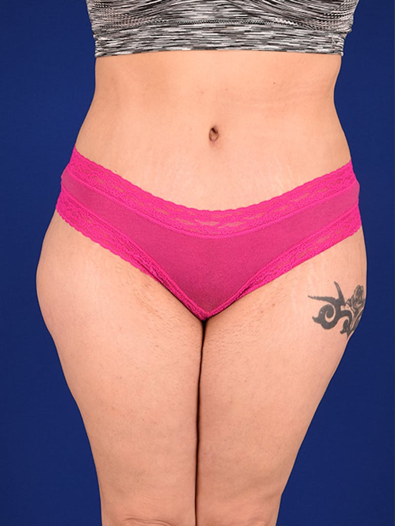 Abdominoplasty / Tummy Tuck Before & After Gallery - Patient 18242776 - Image 2