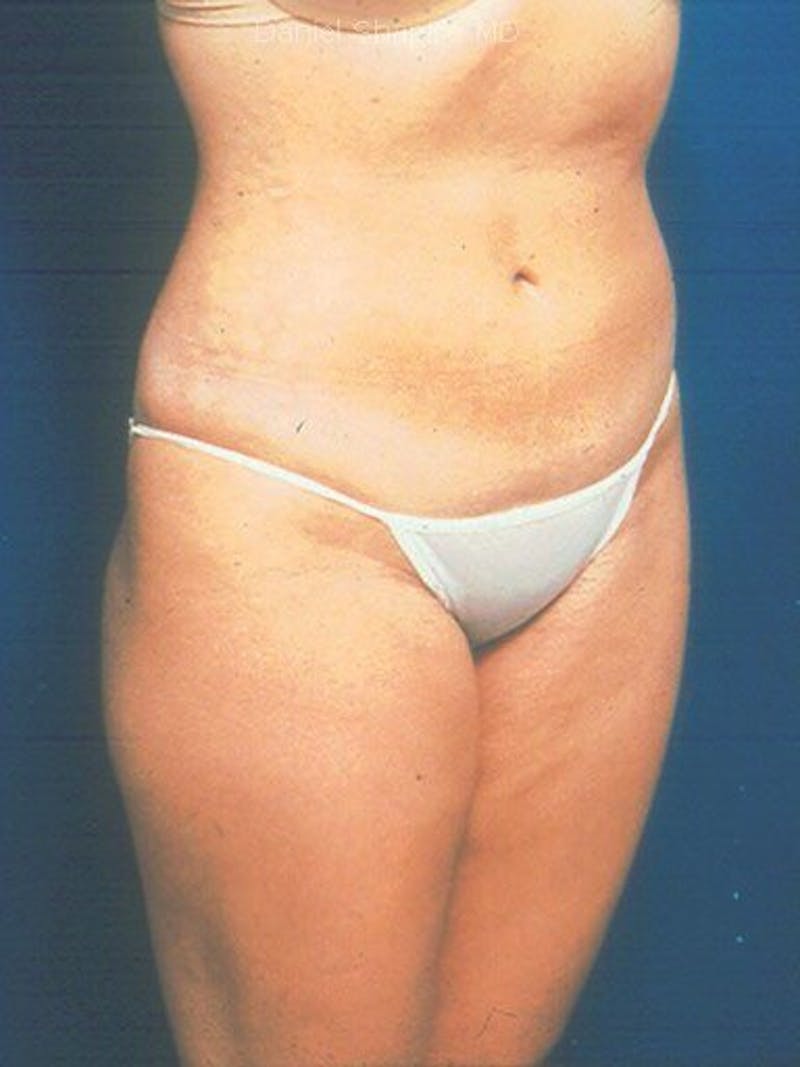 Liposuction Before & After Gallery - Patient 18242613 - Image 2