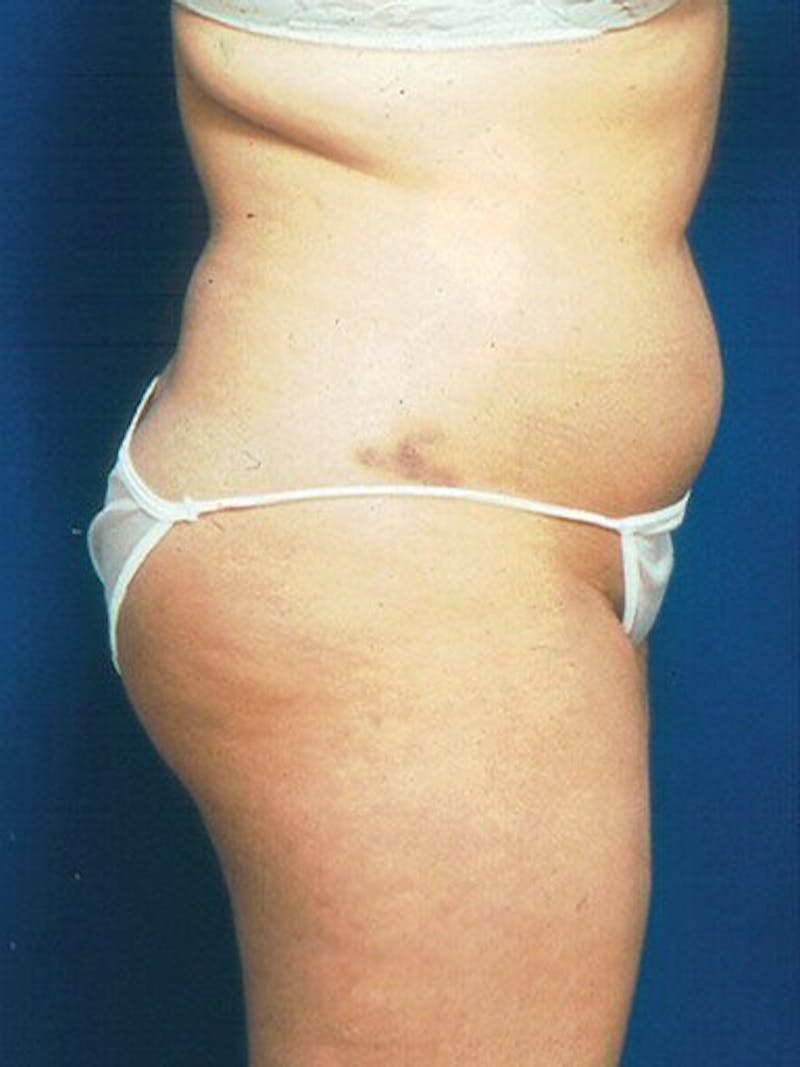 Liposuction Before & After Gallery - Patient 18242613 - Image 3