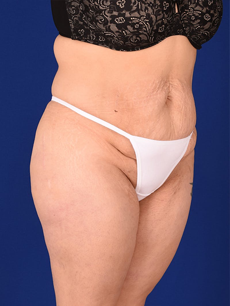 Abdominoplasty / Tummy Tuck Before & After Gallery - Patient 18242776 - Image 3
