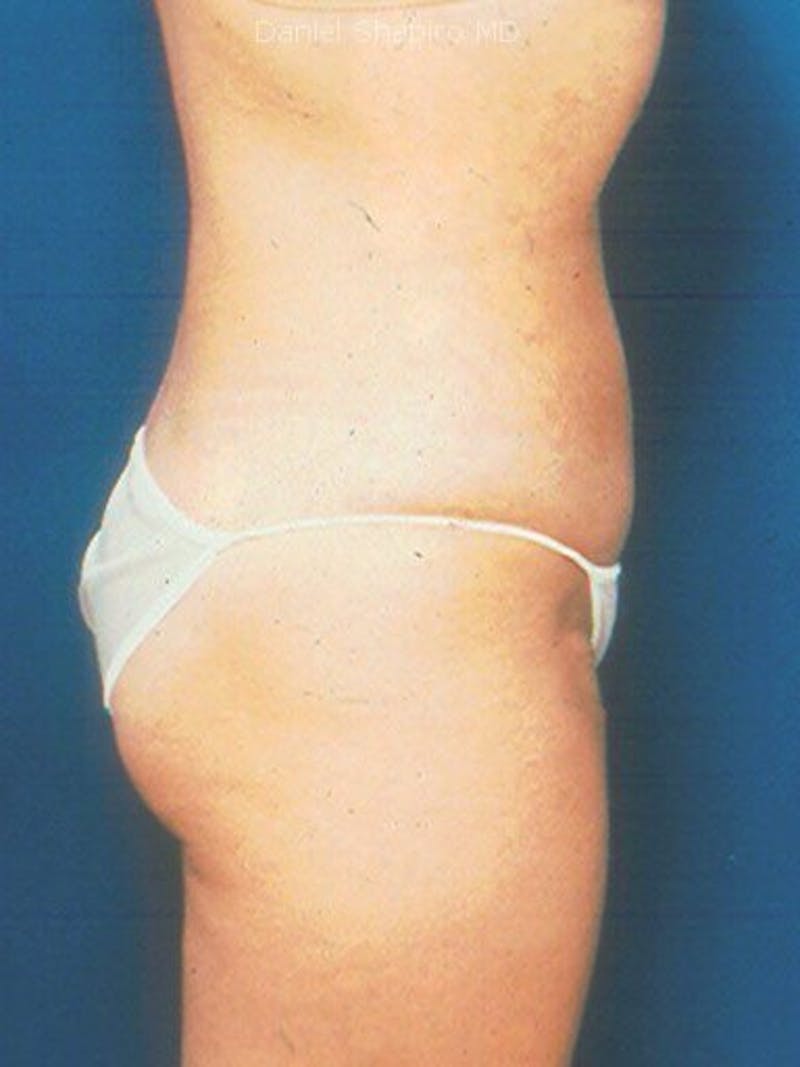 Liposuction Before & After Gallery - Patient 18242613 - Image 4