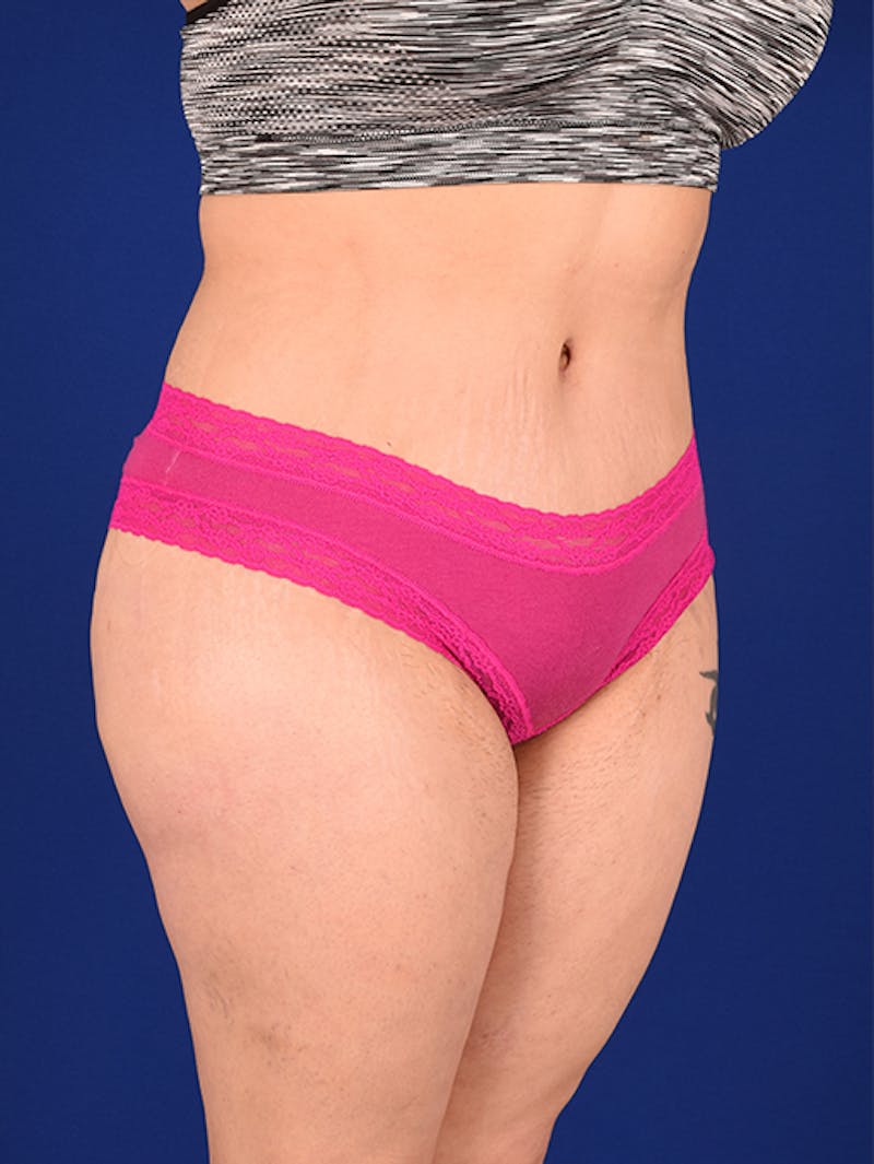 Abdominoplasty / Tummy Tuck Before & After Gallery - Patient 18242776 - Image 4