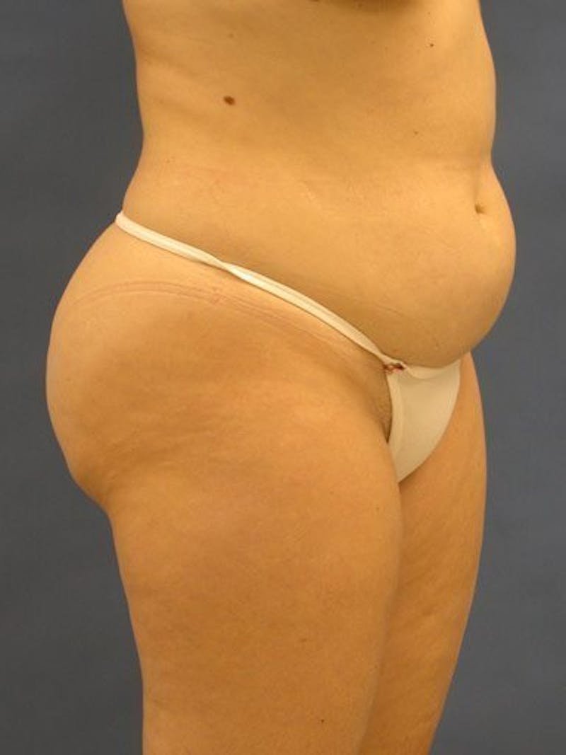 Liposuction Before & After Gallery - Patient 18242778 - Image 1