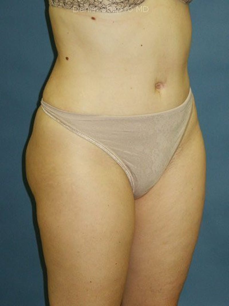 Liposuction Before & After Gallery - Patient 18242778 - Image 2