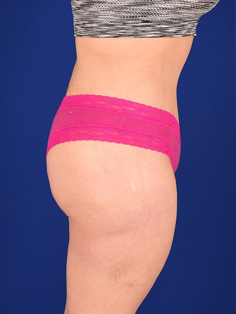 Abdominoplasty / Tummy Tuck Before & After Gallery - Patient 18242776 - Image 6