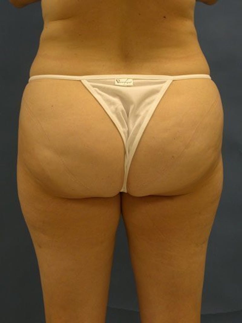 Liposuction Before & After Gallery - Patient 18242778 - Image 3