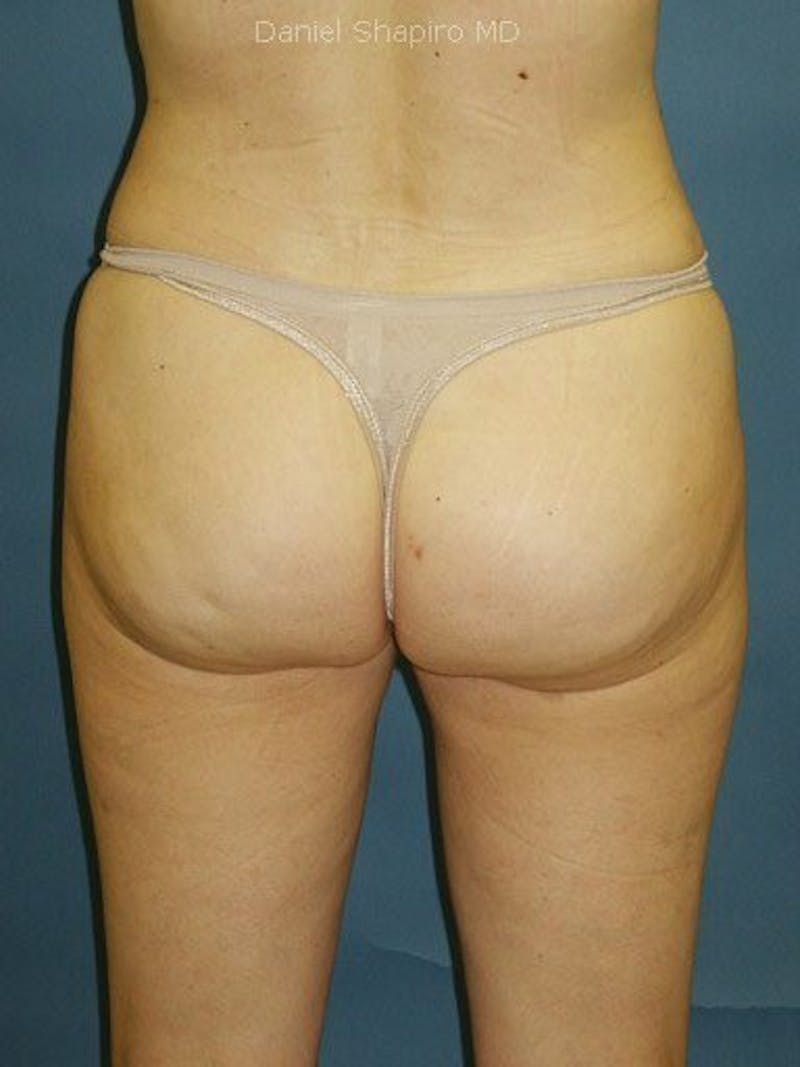 Liposuction Before & After Gallery - Patient 18242778 - Image 4