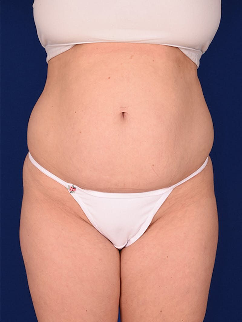 Abdominoplasty / Tummy Tuck Before & After Gallery - Patient 18246019 - Image 1