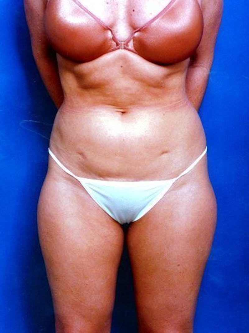 Liposuction Before & After Gallery - Patient 18245863 - Image 1