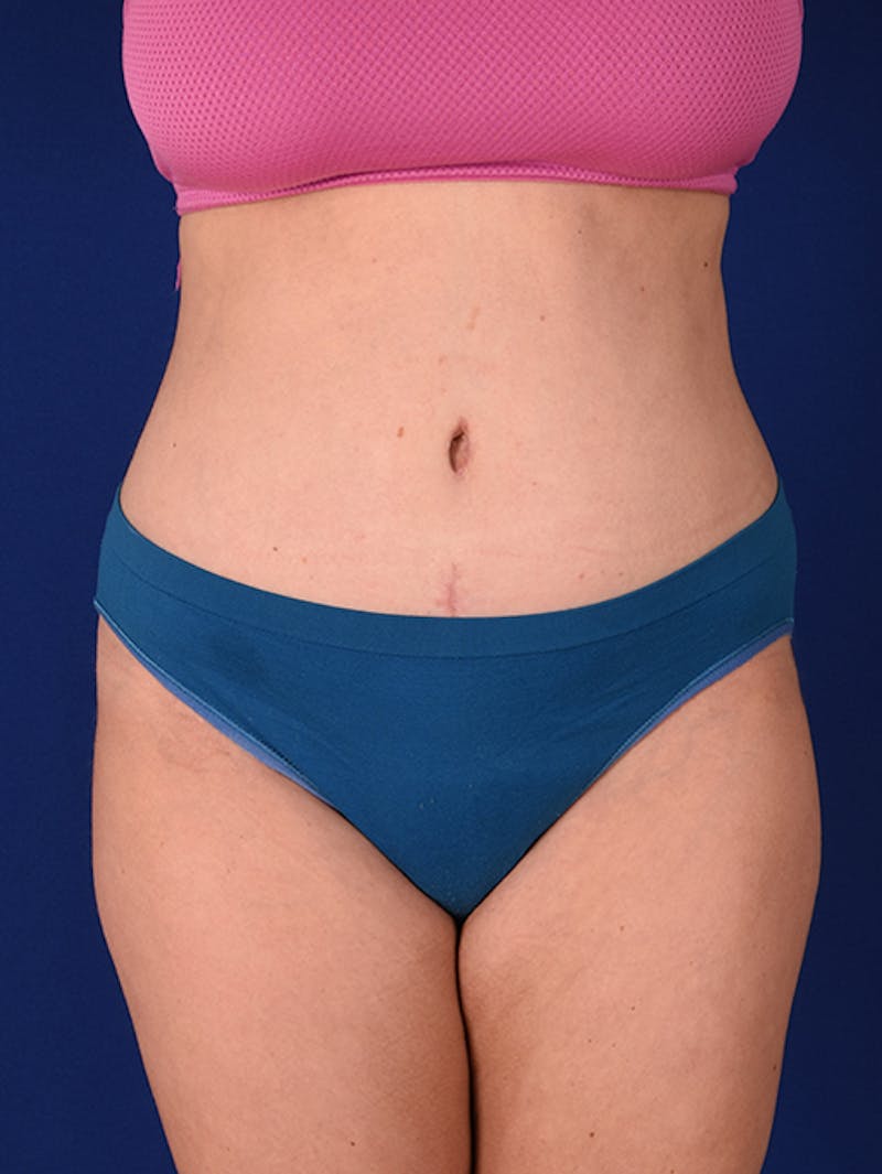 Abdominoplasty / Tummy Tuck Before & After Gallery - Patient 18246019 - Image 2