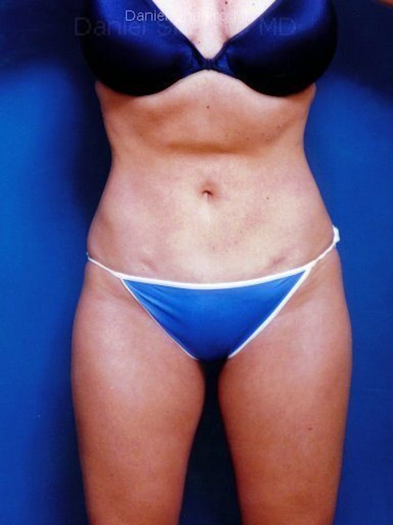 Liposuction Before & After Gallery - Patient 18245863 - Image 2