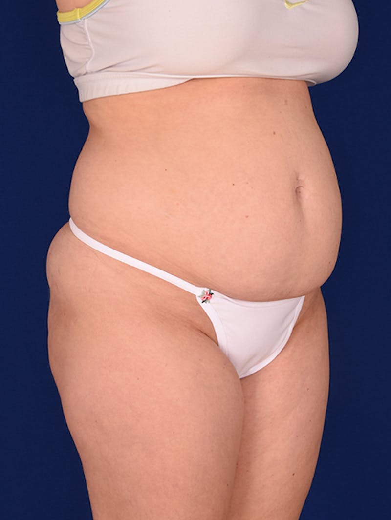 Abdominoplasty / Tummy Tuck Before & After Gallery - Patient 18246019 - Image 3
