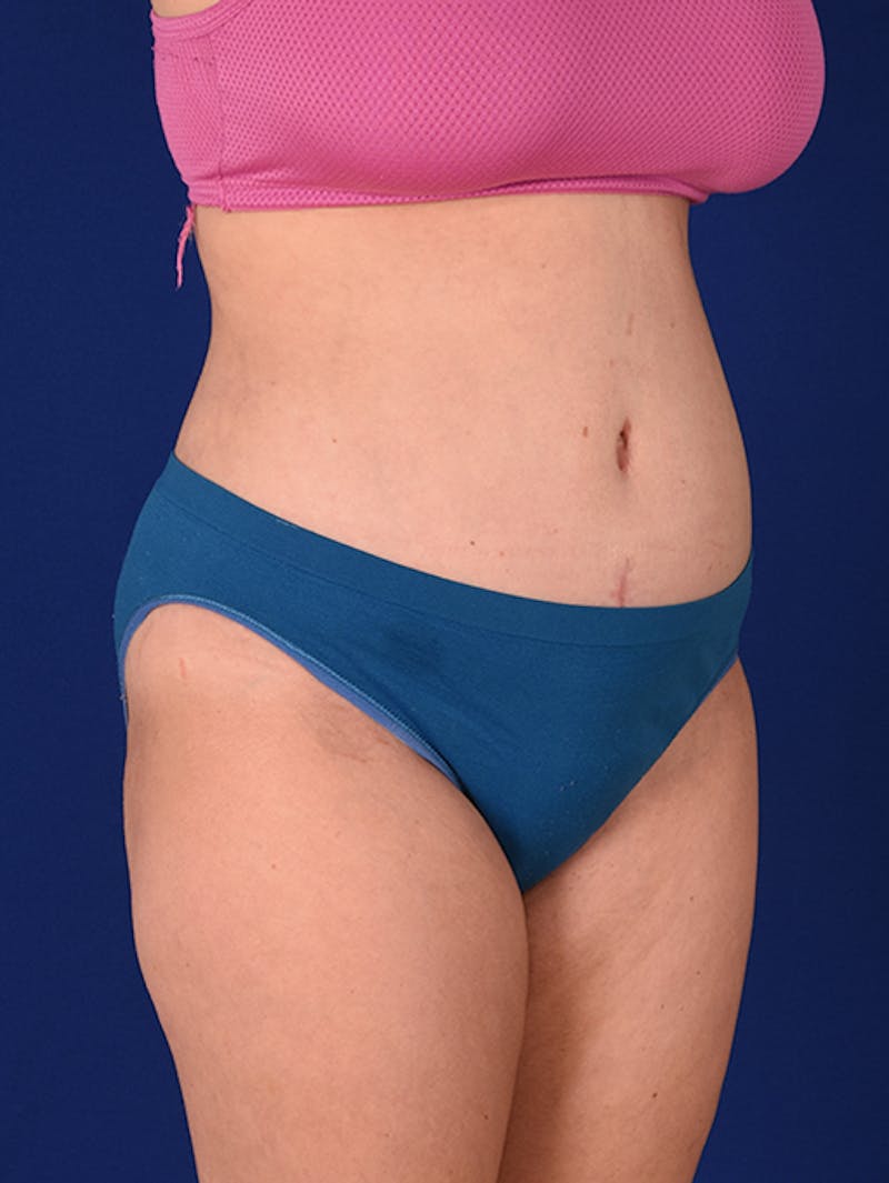 Abdominoplasty / Tummy Tuck Before & After Gallery - Patient 18246019 - Image 4