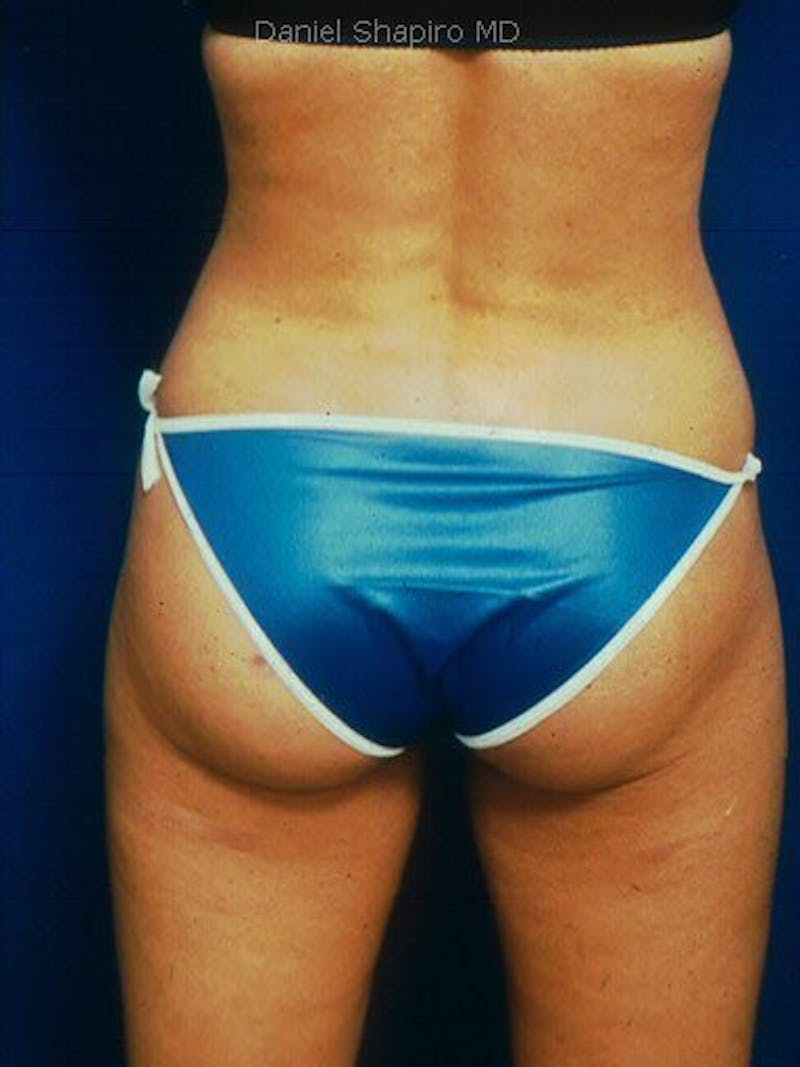Liposuction Before & After Gallery - Patient 18245863 - Image 4