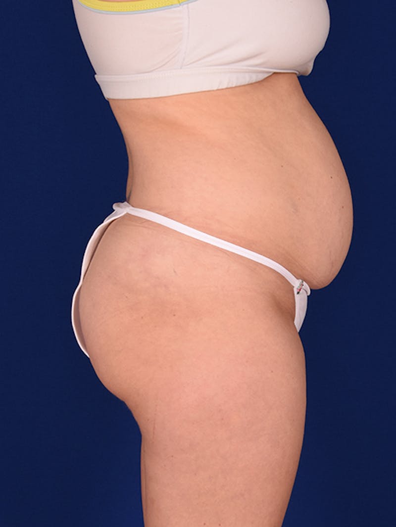 Abdominoplasty / Tummy Tuck Before & After Gallery - Patient 18246019 - Image 5