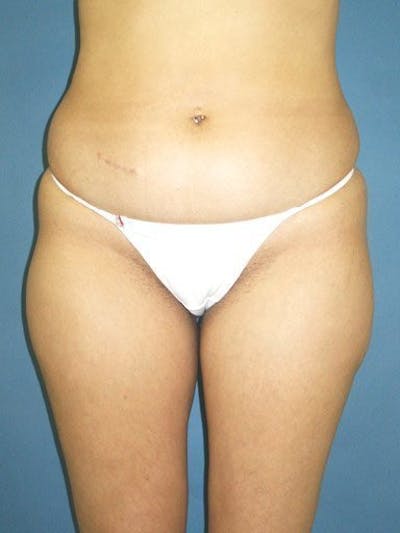 Liposuction Before & After Gallery - Patient 18246022 - Image 1