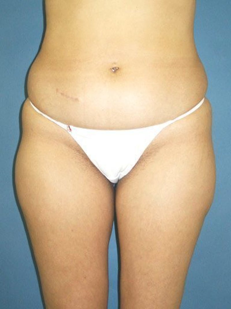 Liposuction Before & After Gallery - Patient 18246022 - Image 1