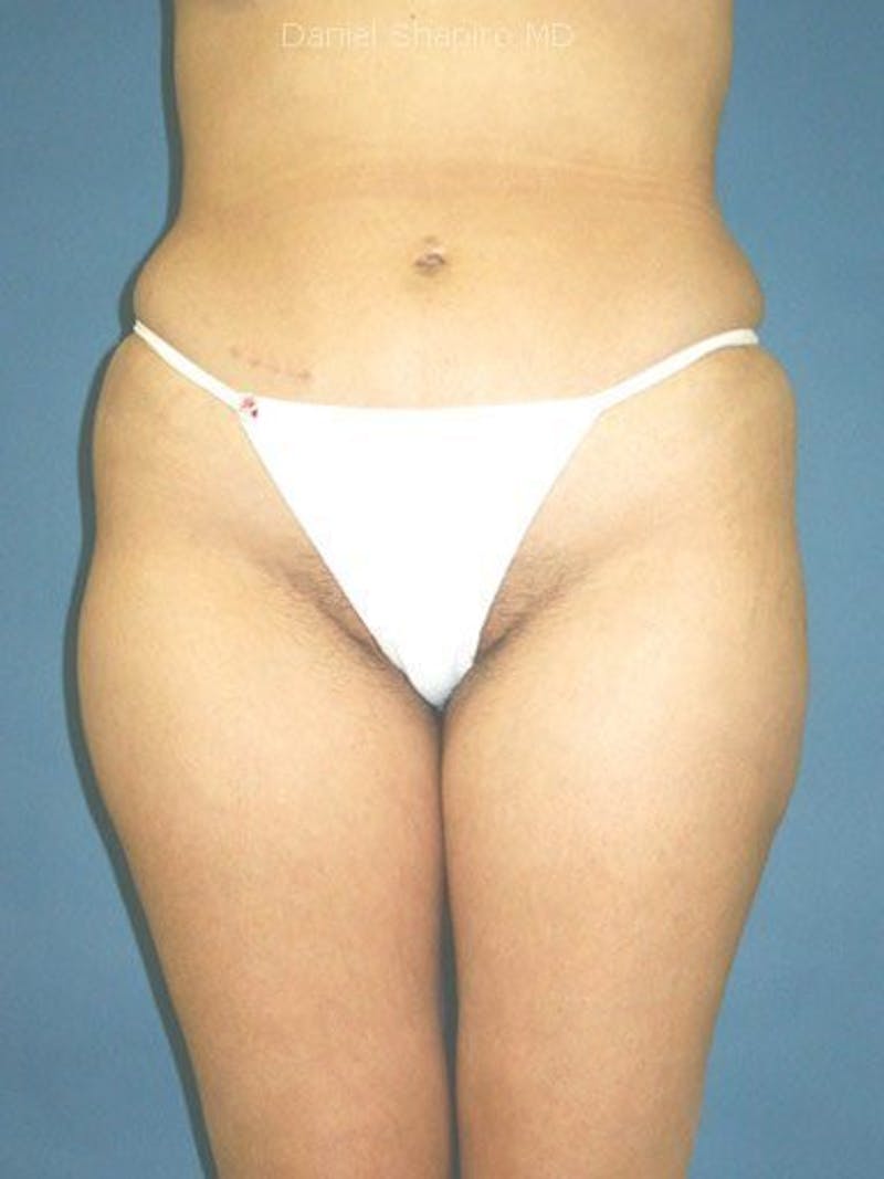 Liposuction Before & After Gallery - Patient 18246022 - Image 2