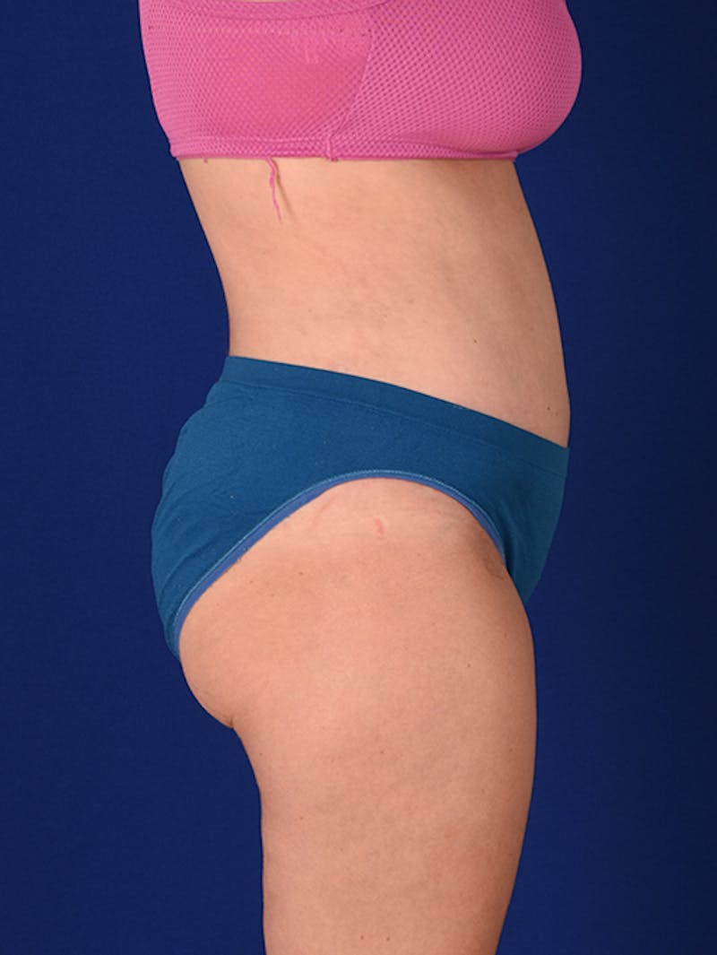 Abdominoplasty / Tummy Tuck Before & After Gallery - Patient 18246019 - Image 6