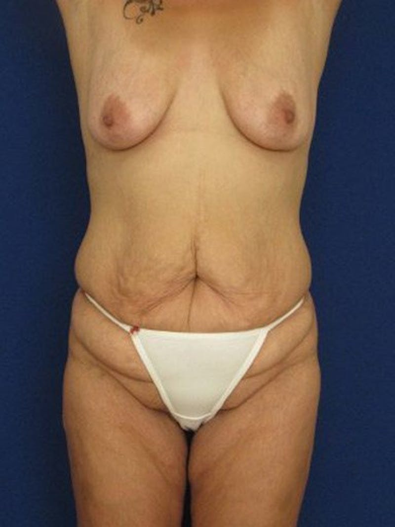 Mommy Makeover Before & After Gallery - Patient 18246023 - Image 1