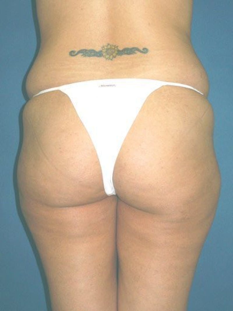 Liposuction Before & After Gallery - Patient 18246022 - Image 3