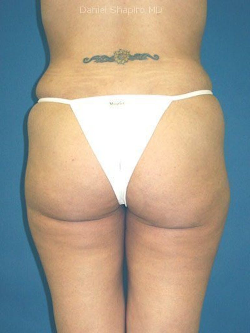 Liposuction Before & After Gallery - Patient 18246022 - Image 4