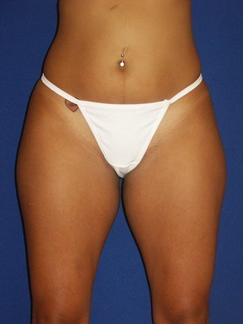 Liposuction Before & After Gallery - Patient 18246177 - Image 1