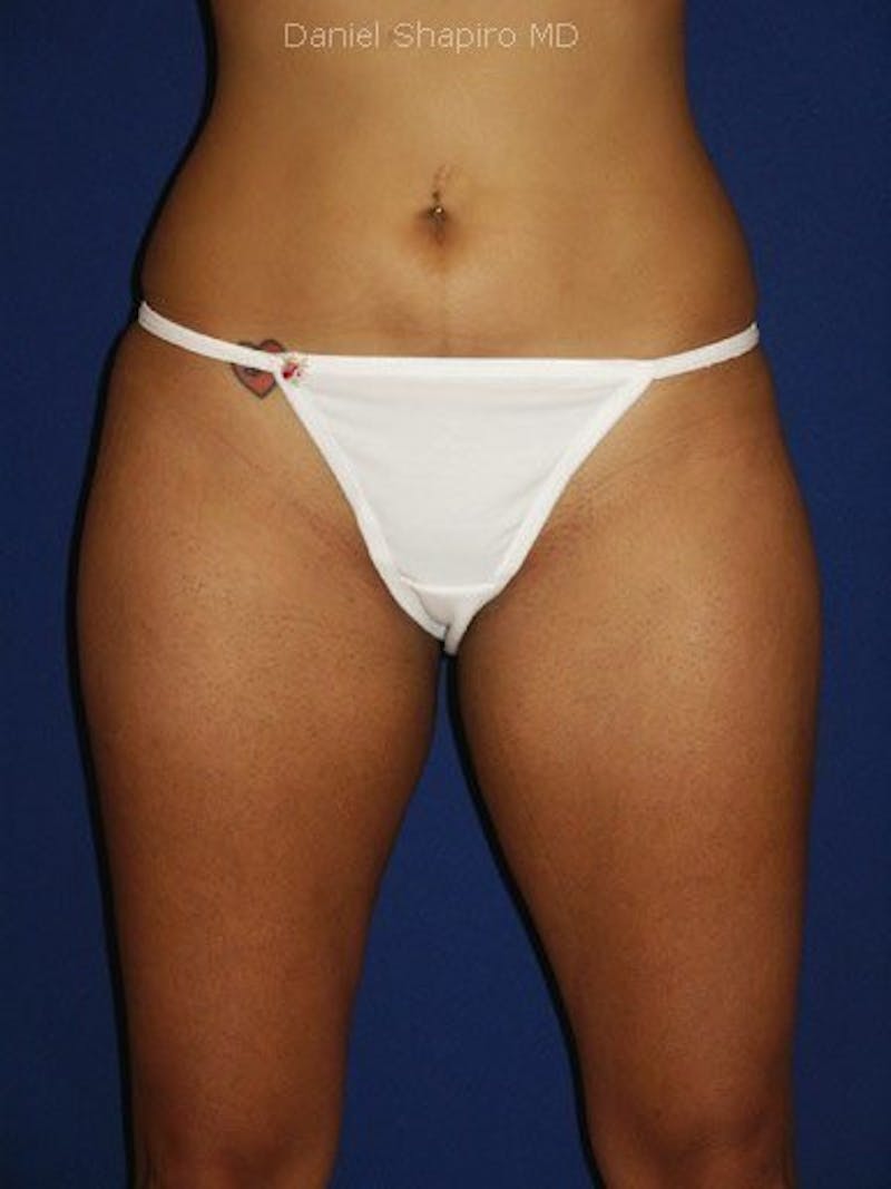 Liposuction Before & After Gallery - Patient 18246177 - Image 2