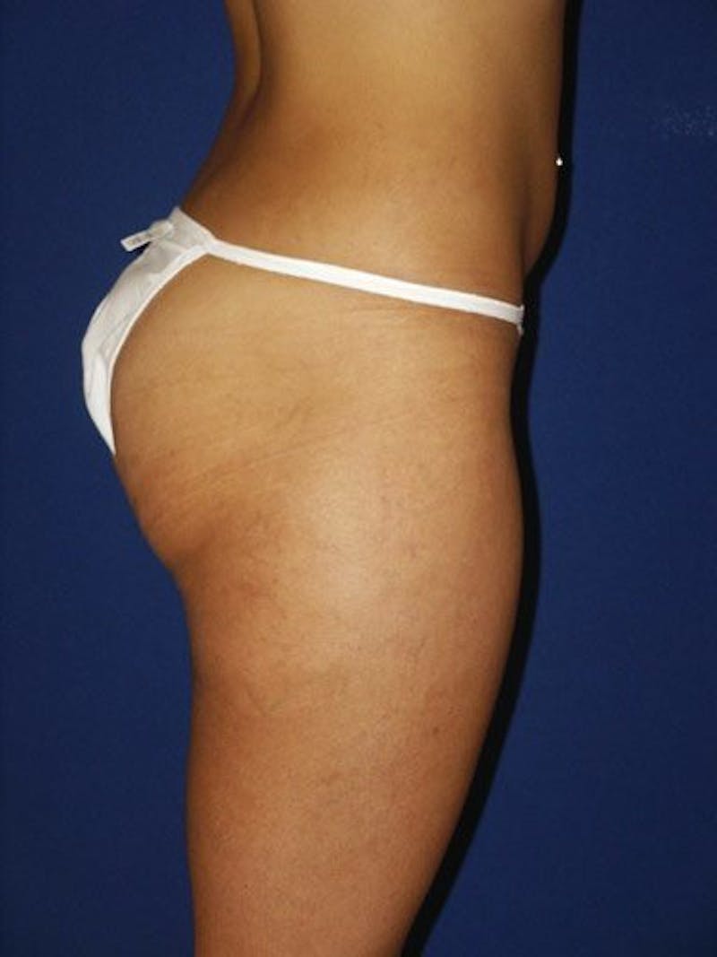 Liposuction Before & After Gallery - Patient 18246177 - Image 3
