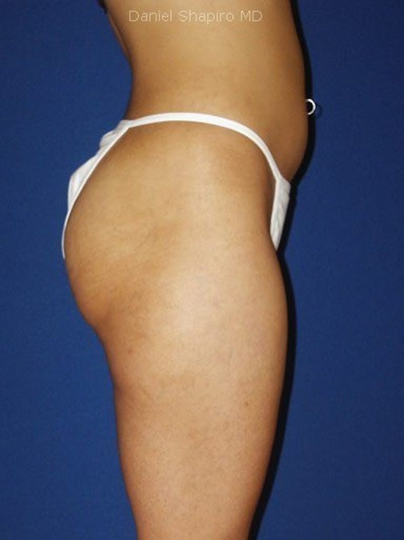 Liposuction Before & After Gallery - Patient 18246177 - Image 4