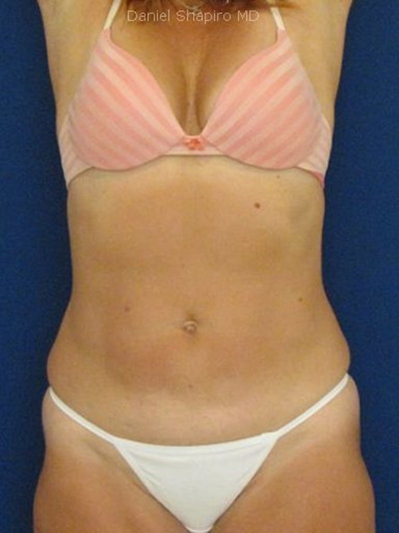 Liposuction Before & After Gallery - Patient 18246337 - Image 2