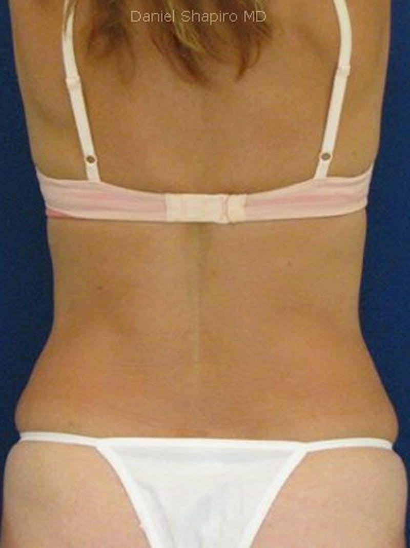 Liposuction Before & After Gallery - Patient 18246337 - Image 4