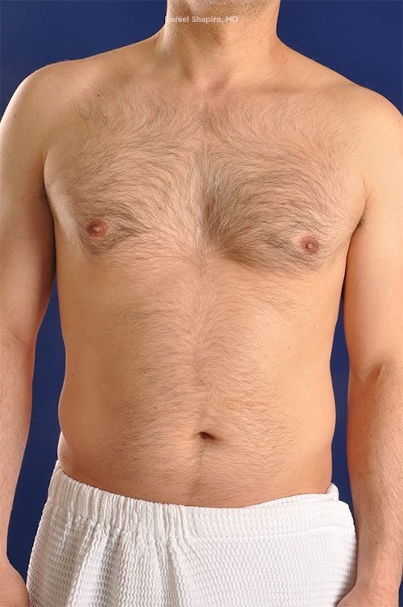 Male Hi-Def Liposuction Before & After Gallery - Patient 18258839 - Image 1