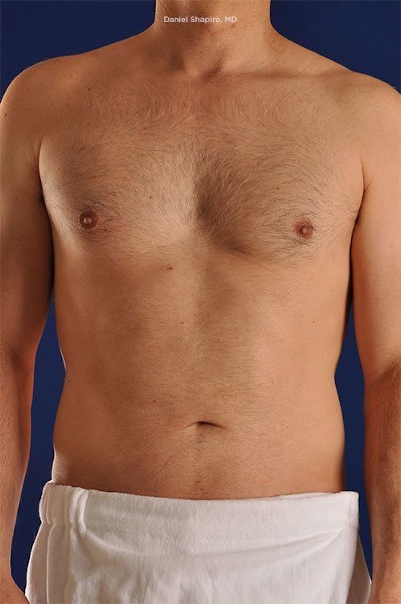 Male Hi-Def Liposuction Before & After Gallery - Patient 18258839 - Image 2