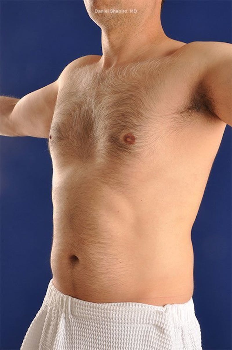 Male Hi-Def Liposuction Before & After Gallery - Patient 18258839 - Image 3