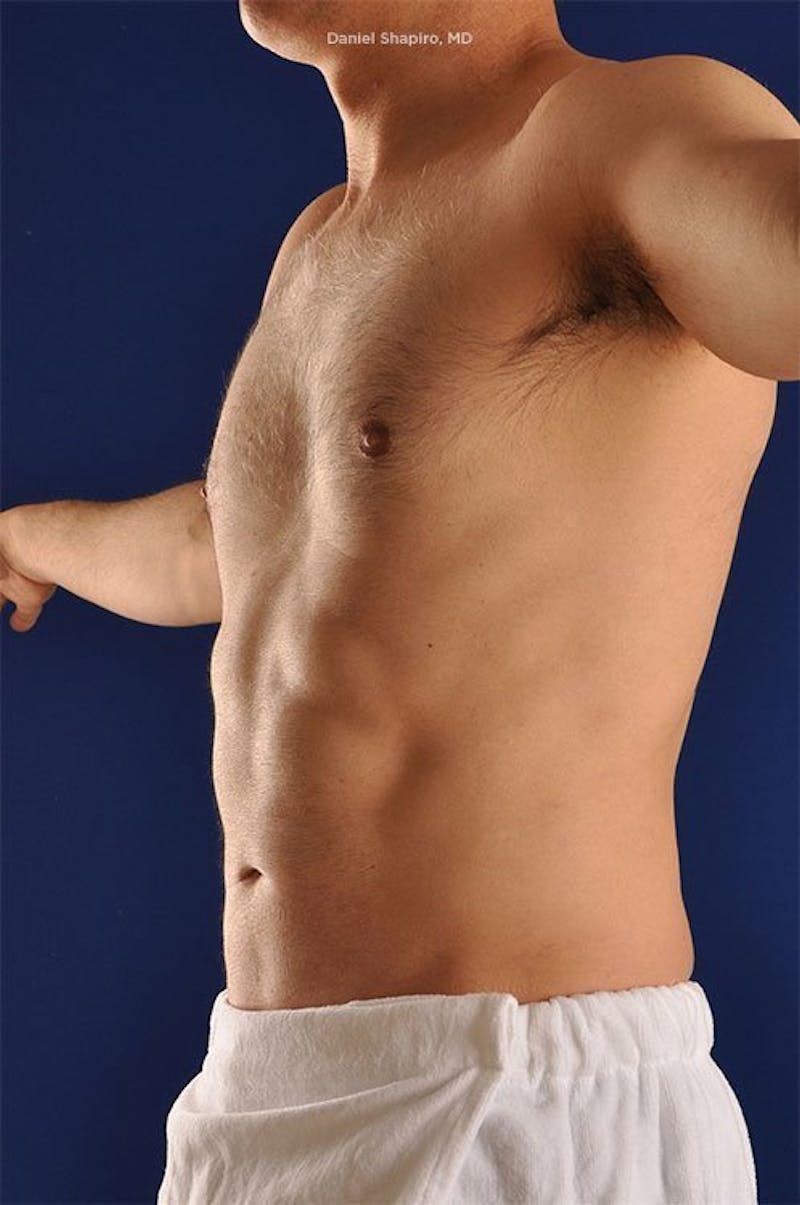 Male Hi-Def Liposuction Before & After Gallery - Patient 18258839 - Image 4
