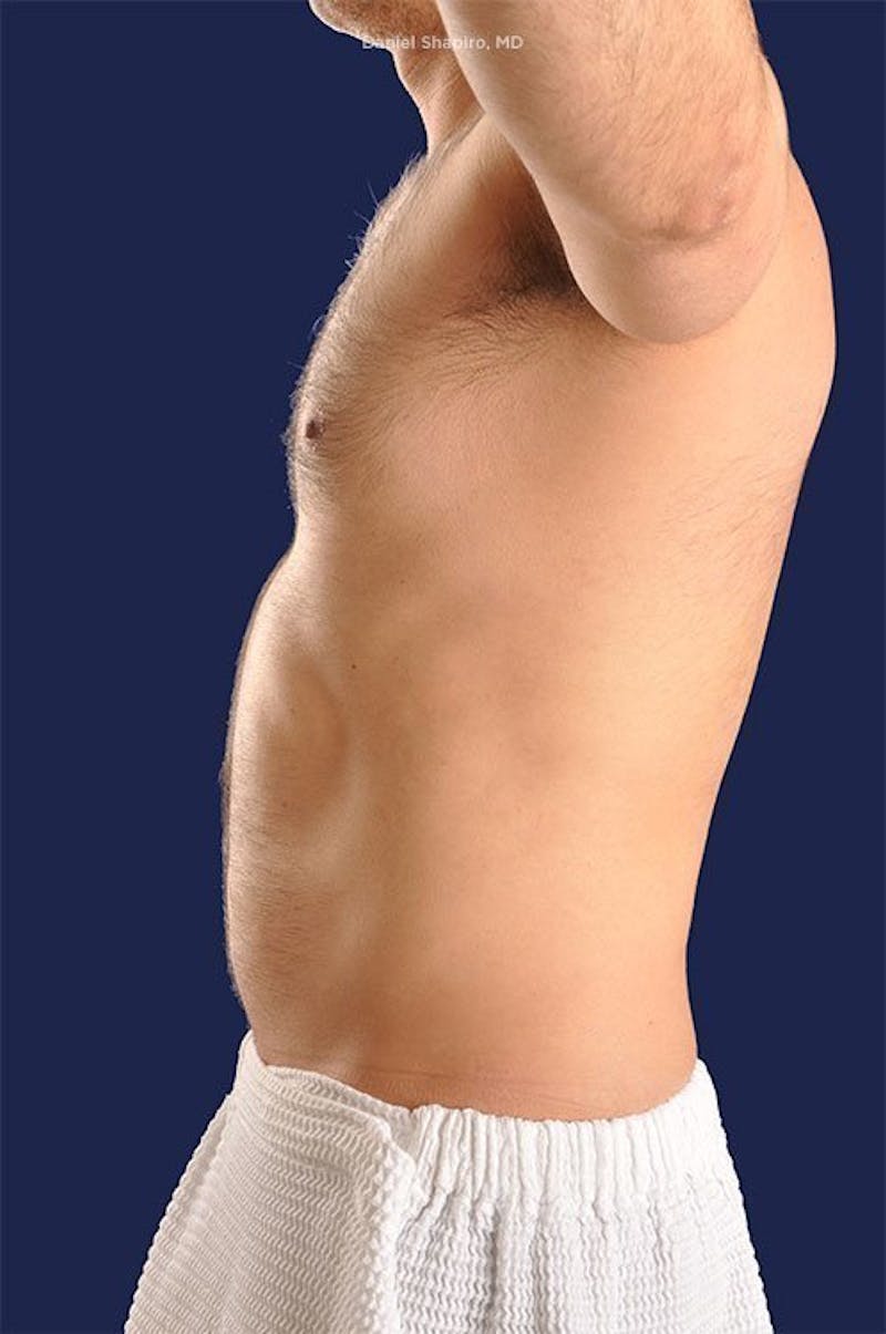 Male Hi-Def Liposuction Before & After Gallery - Patient 18258839 - Image 5